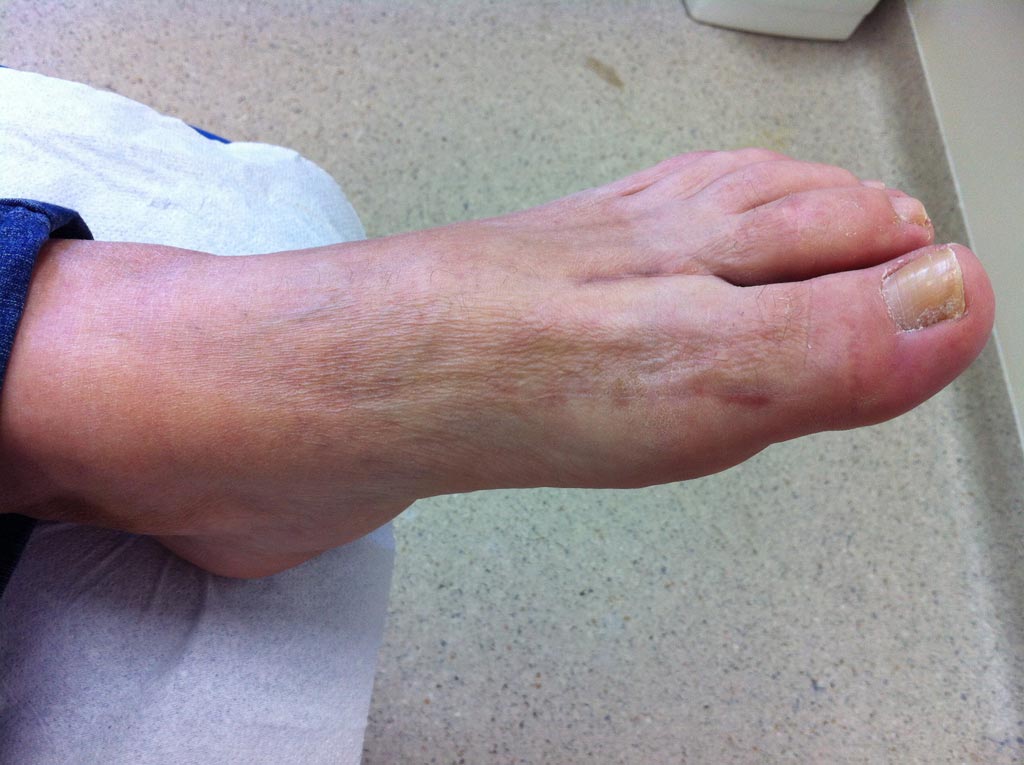 liječenje deformiteta nožne artroze